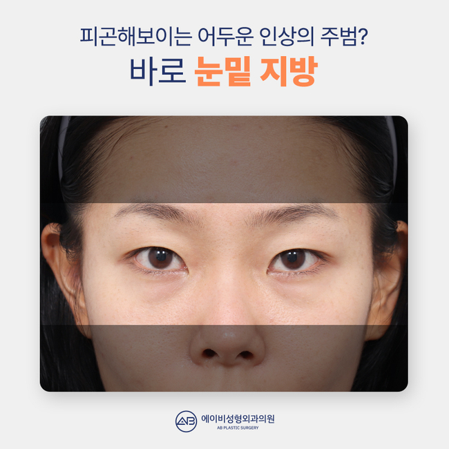 에이비 나노 눈밑지 이게 뭔데? 관련 이미지 2