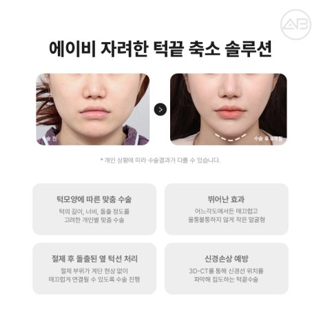 자연스럽고 조화로운 자려한안면윤곽을 원한다면 AB성형외과 관련 이미지 11