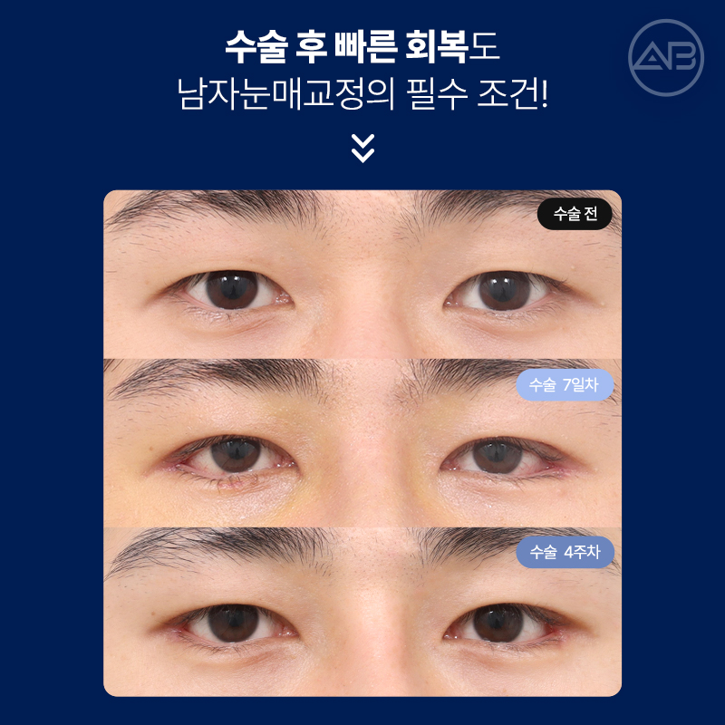 인상을 바꾸는 첫 시작, 에이비성형외과 남자눈성형 관련 이미지 13