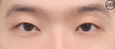 AB Plastic Surgery Men’s Eye Surgery - First Snow Case Review image 1