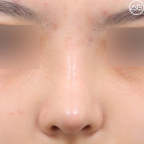 Case Review of Bulbous Nose Surgery That Transformed the Face into a Natural and Refined Look (feat. AB Plastic Surgery) image 5