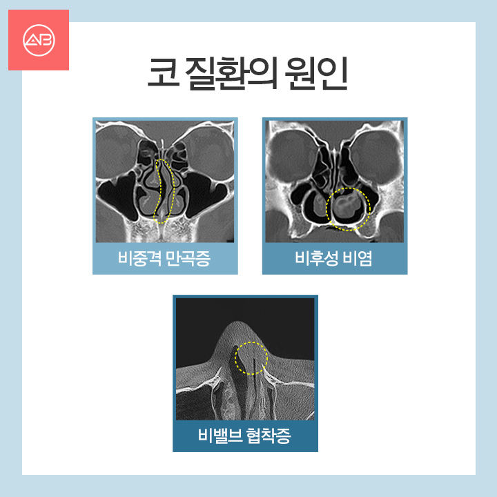 기능코성형 실비 제대로 알고 받기 관련 이미지 3