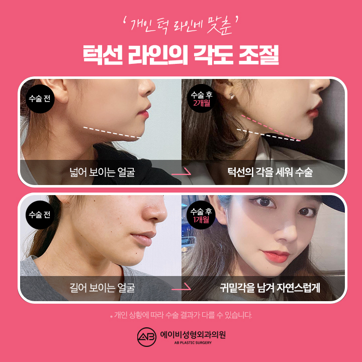 Trust AB Plastic Surgery, the Best Place for Square Jaw Surgery image 3