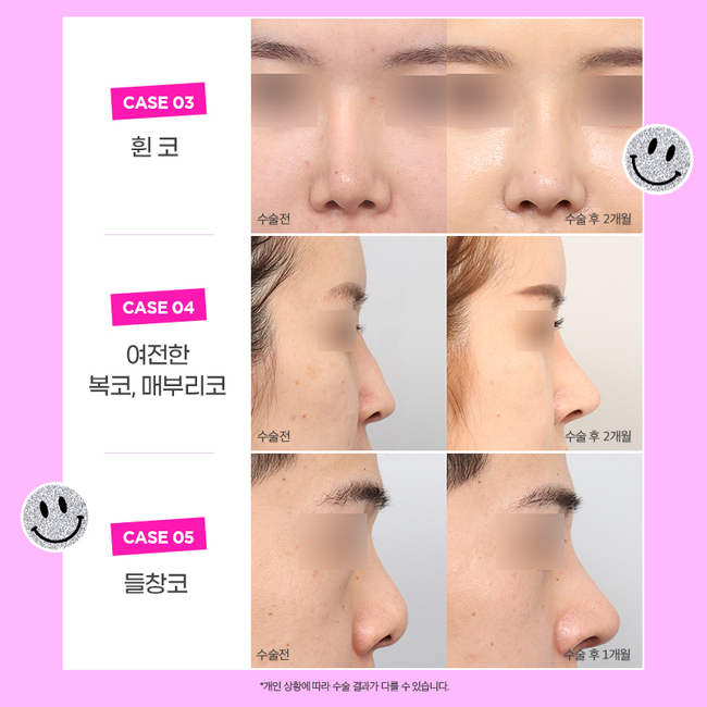 Reasonable Rhinoplasty Revision Costs at AB Plastic Surgery image 5
