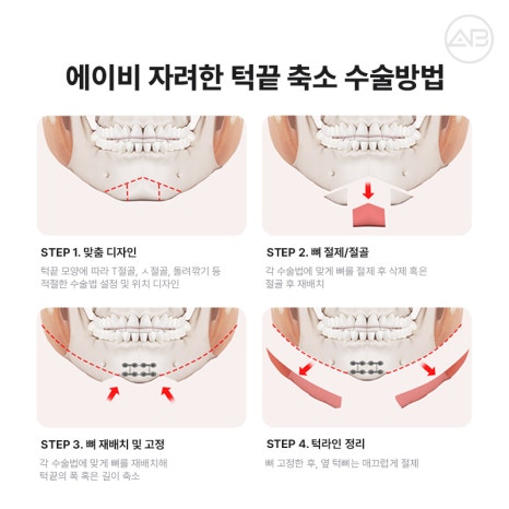 자연스럽고 조화로운 자려한안면윤곽을 원한다면 AB성형외과 관련 이미지 10