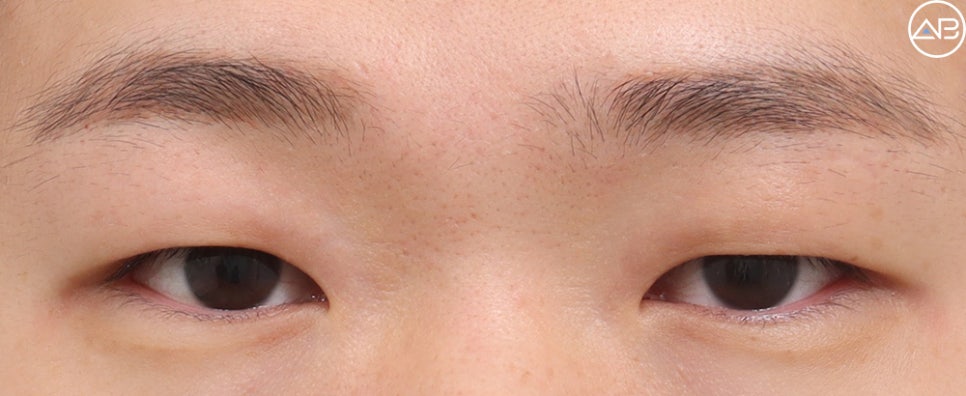 AB Plastic Surgery Male Eye Surgery Case Review (Feat. Director Ahn Moon-young) image 1