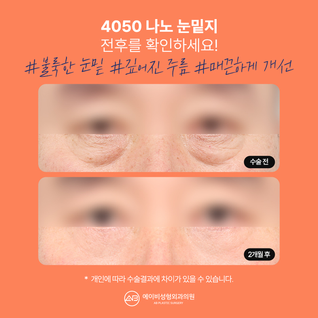 에이비 나노 눈밑지 이게 뭔데? 관련 이미지 6