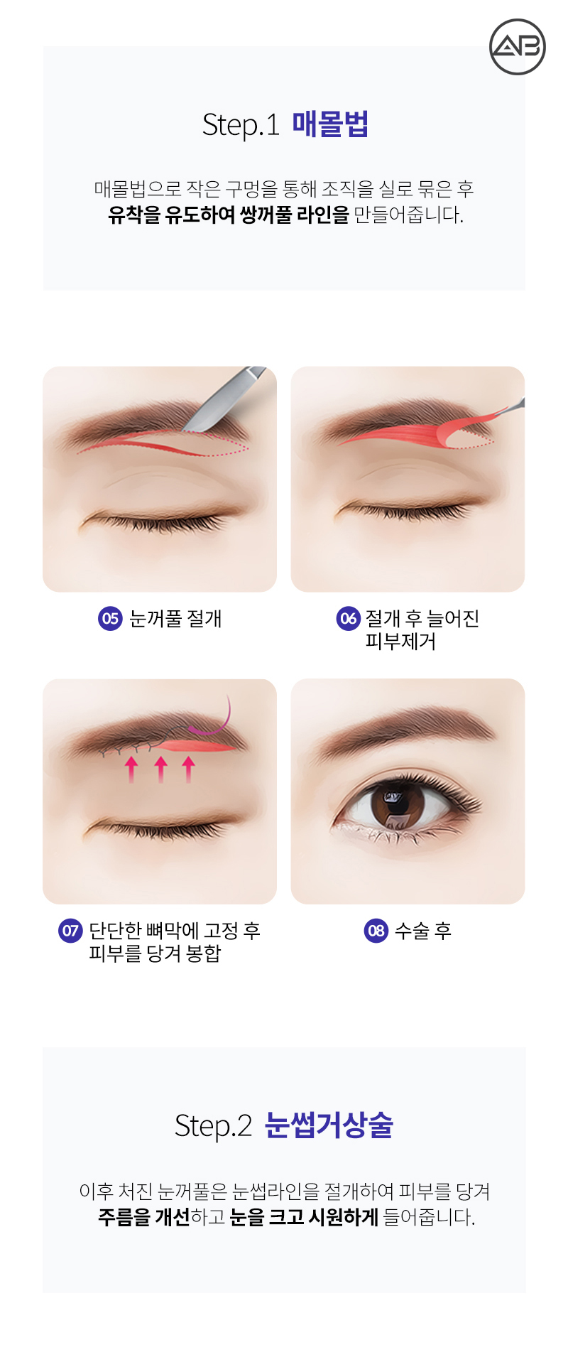 중년눈성형 퀵아이리프팅 하나면 끝 관련 이미지 5