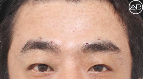 Severe Ptosis: Which Surgery Is Effective? image 2