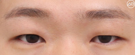AB Plastic Surgery Male Eye Surgery Case Review (Feat. Director Ahn Moon-young) image 5