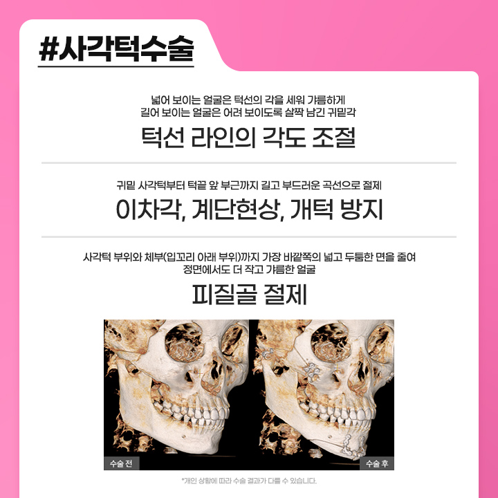안면윤곽수술후붓기 때문에 걱정된다면 관련 이미지 4