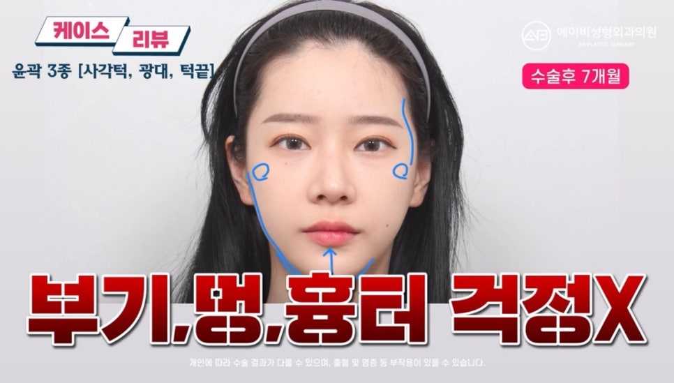 #에이비성형외과#에이비tv#케이스리뷰#윤곽3종수술 관련 이미지 7