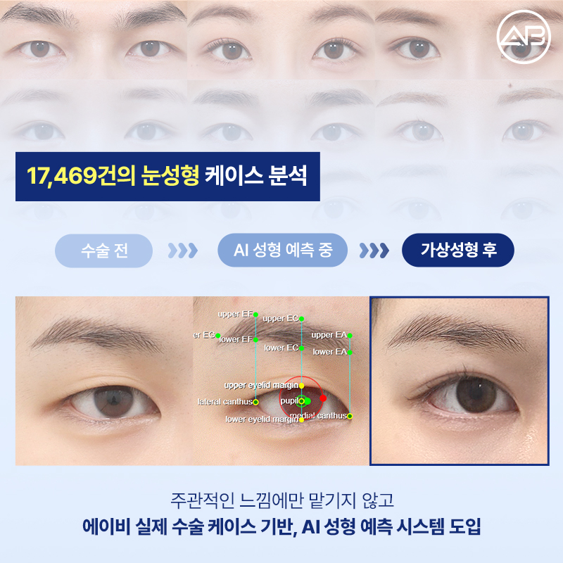 에이비성형외과 AI 가상 눈성형 원하는 결과를 미리 볼 수 있다! 관련 이미지 2