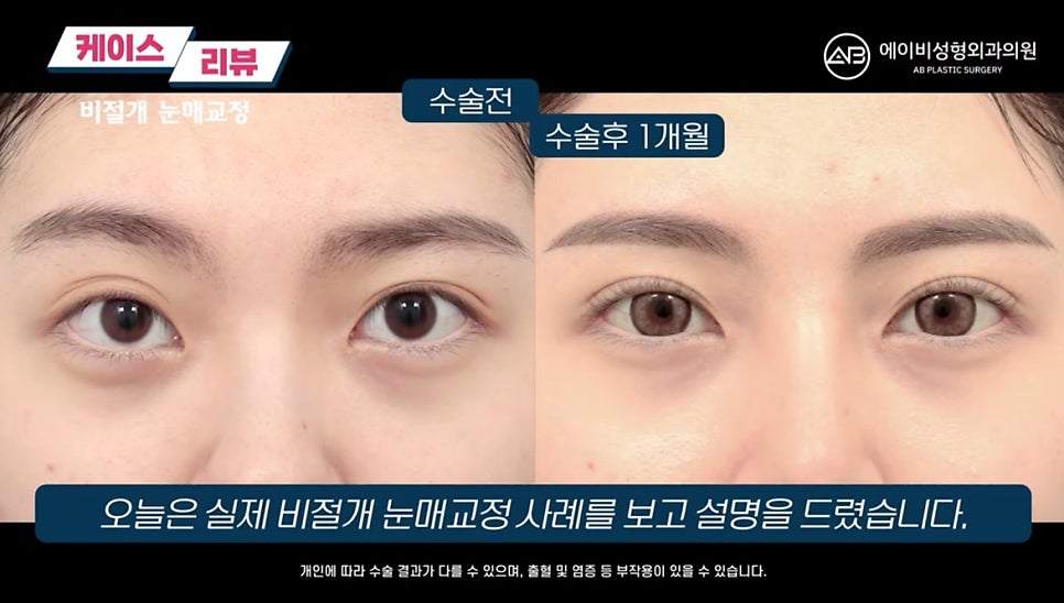 #AB Plastic Surgery #AB TV #Eye Surgery #Non-Incisional Ptosis Correction image 6