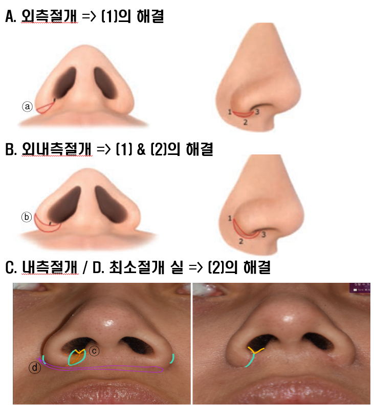 Q. Nose tip surgery, alar reduction, and bulbous nose surgery all look similar. Are they different surgeries? image 4