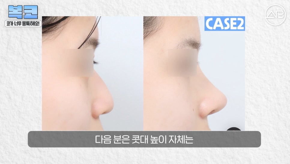 #에이비성형외과#에이비tv#코성형#복코성형 관련 이미지 16