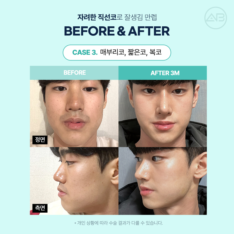남자직선코성형 왜 에이비성형외과일까? 관련 이미지 12