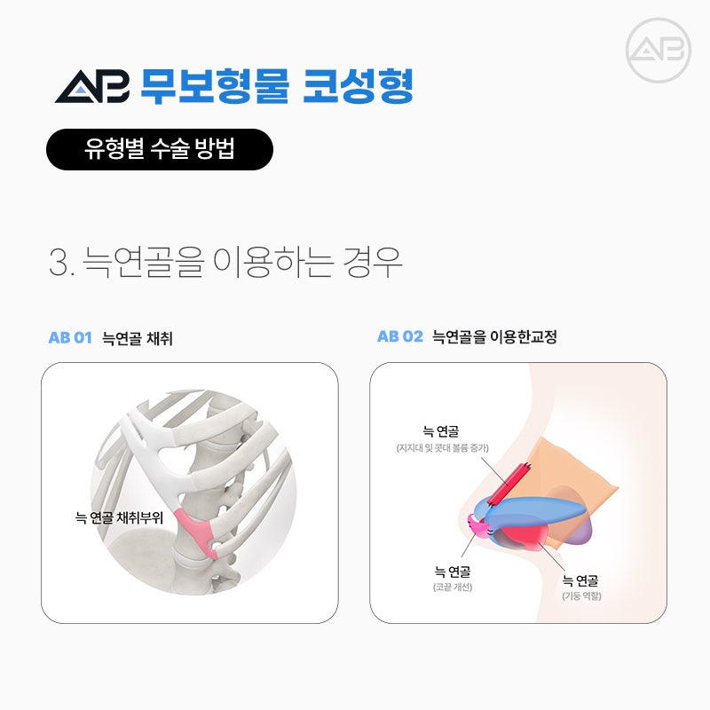 무보형물코성형 임상경험이 풍부한 에이비성형외과 관련 이미지 6