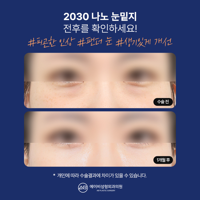 에이비 나노 눈밑지 이게 뭔데? 관련 이미지 5