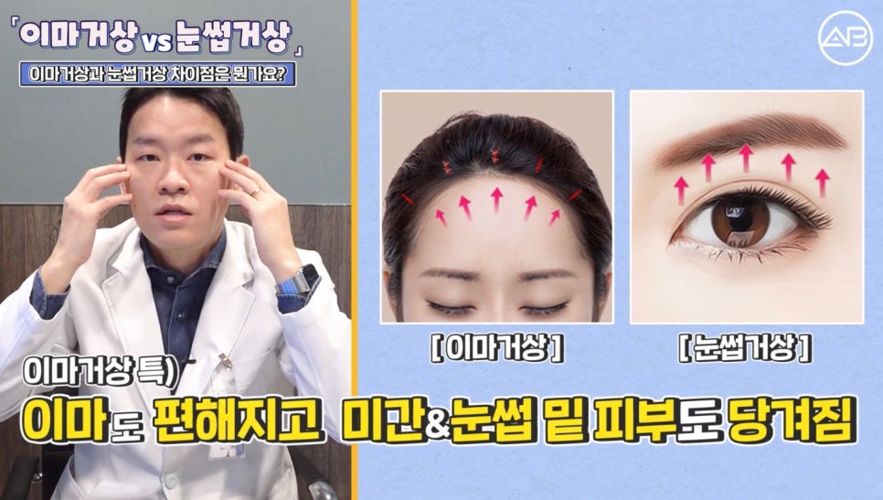 #AB Plastic Surgery #AB TV #Forehead Lift #Brow Lift image 7
