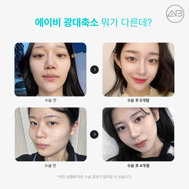 에이비성형외과 광대축소 부드럽고 갸름하게 관련 이미지 2
