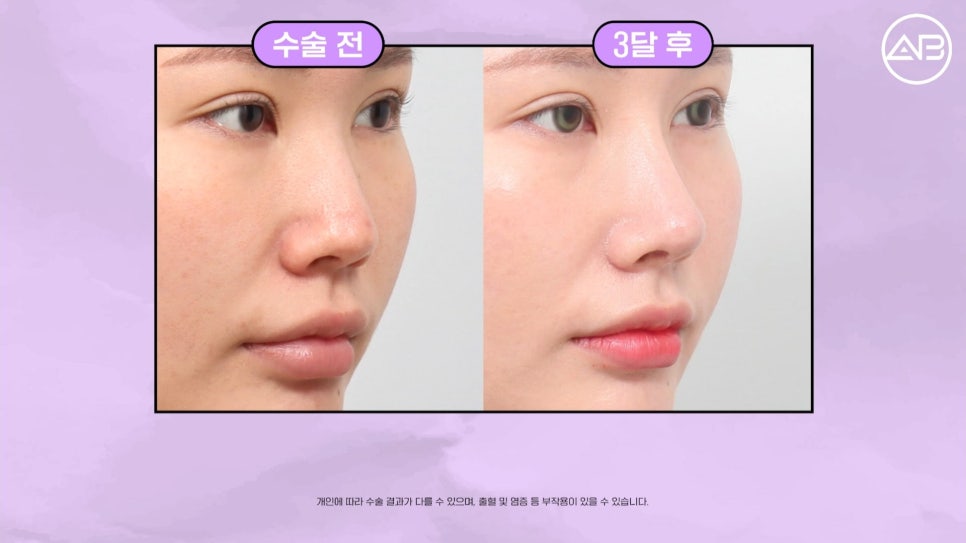 #에이비성형외과#에이비tv#케이스리뷰#코성형 관련 이미지 6