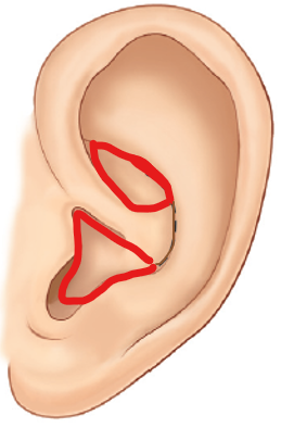 Q. If I get ear piercings, will I be unable to use ear cartilage later for nose surgery? image 1