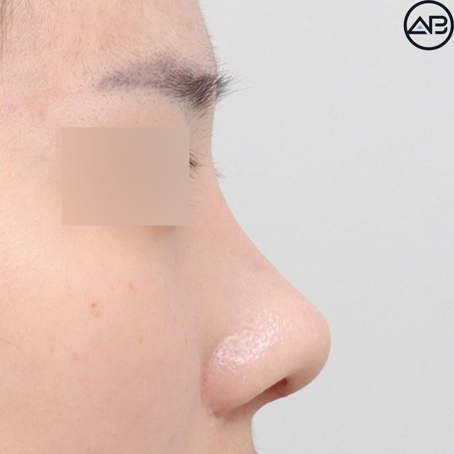 에이비성형외과 자려한코성형 케이스리뷰 관련 이미지 9