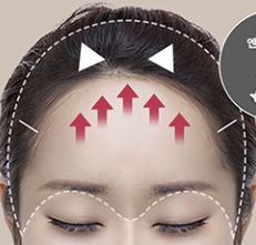 Q. The space between my eyebrows and eyes is narrow, and my eyelids are droopy, so I’ve consulted several places, but everyone recommends something different. What are the differences between ptosis correction, forehead lift, and brow lift under the eyebrow? image 2