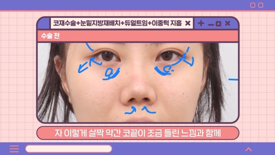 #AB Plastic Surgery #AB TV ##Case Review #Eye Surgery #Nose Revision Surgery image 2