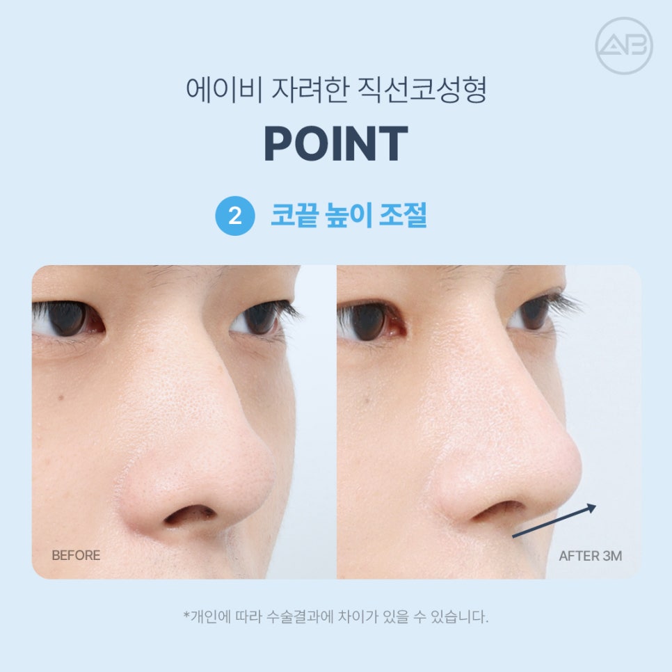 AB성형외과 자려한직선코성형 원조는 다르네 관련 이미지 4