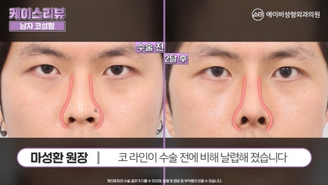 #에이비성형외과#에이비tv#케이스리뷰#남자코성형 관련 이미지 5