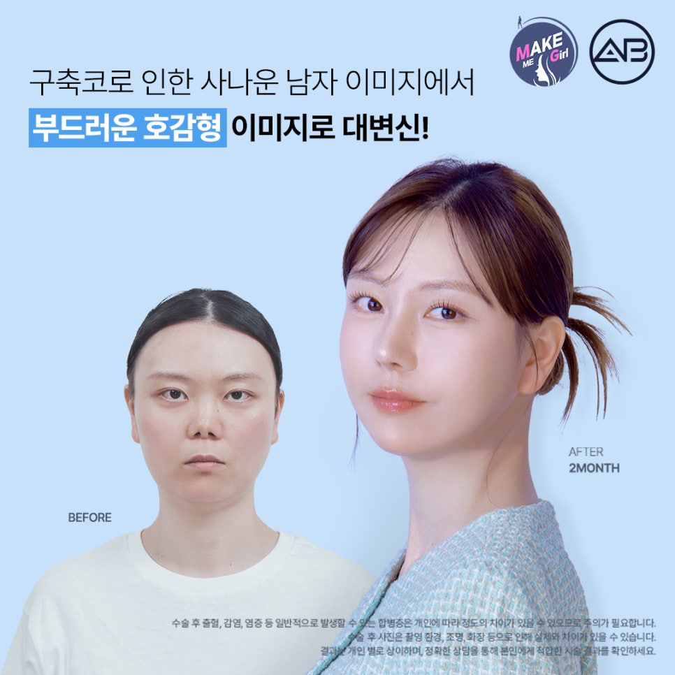 AB Plastic Surgery Contracted Nose Autologous Rib Short Nose Revision Correction Before and After image 1