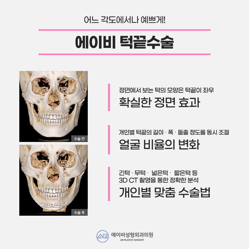 안면윤곽3종수술 솔루션은 에이비! 관련 이미지 3