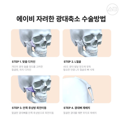 자연스럽고 조화로운 자려한안면윤곽을 원한다면 AB성형외과 관련 이미지 6
