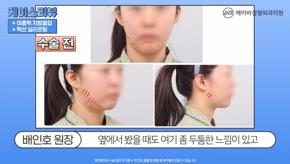 #AB Plastic Surgery #AB TV #Case Review #Double Chin Liposuction image 1
