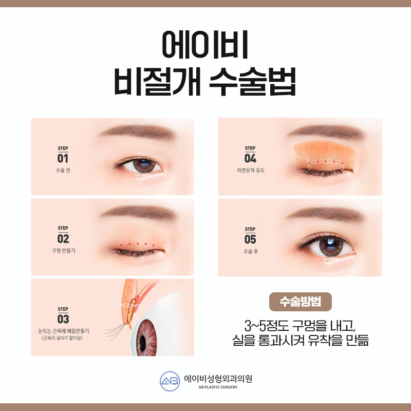 안검하수수술 부담없이 관련 이미지 4