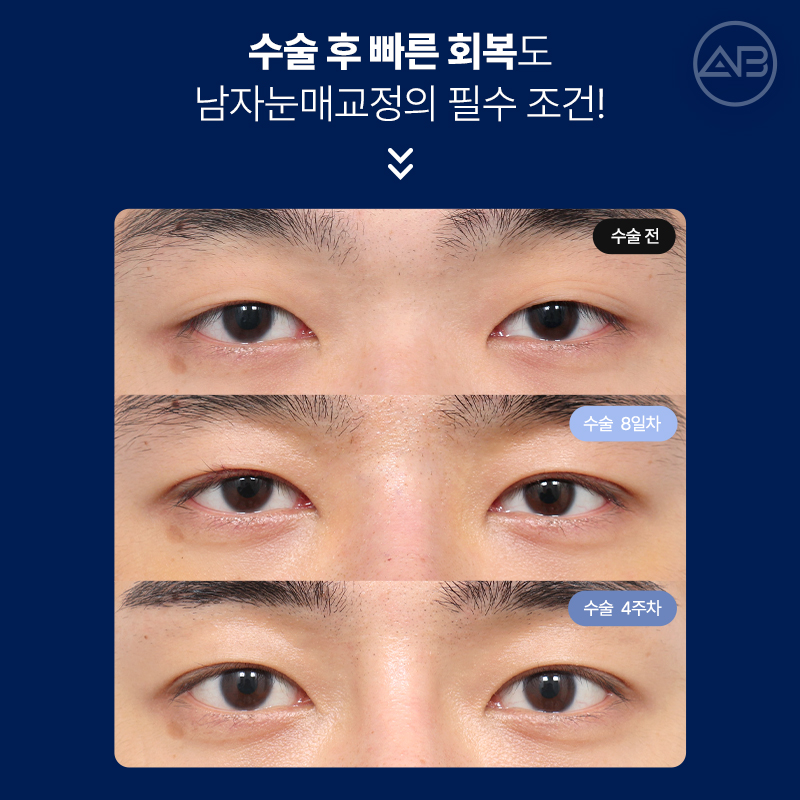 인상을 바꾸는 첫 시작, 에이비성형외과 남자눈성형 관련 이미지 12