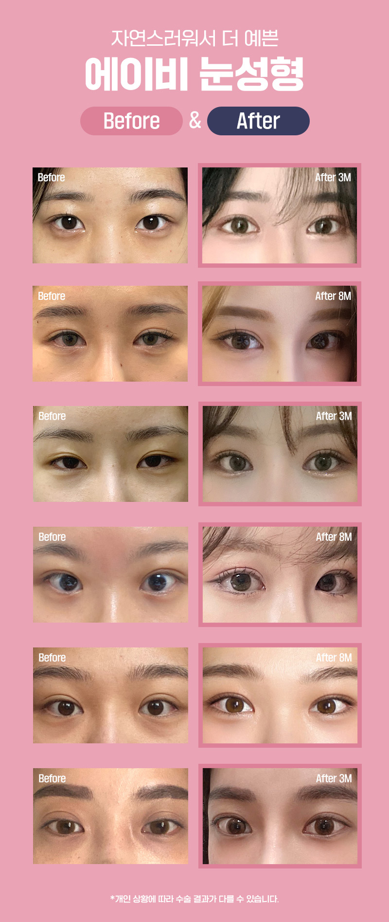 [칼럼] 속눈썹 눈찌름 , 수술로 좋아질 수 있을까요? 관련 이미지 5