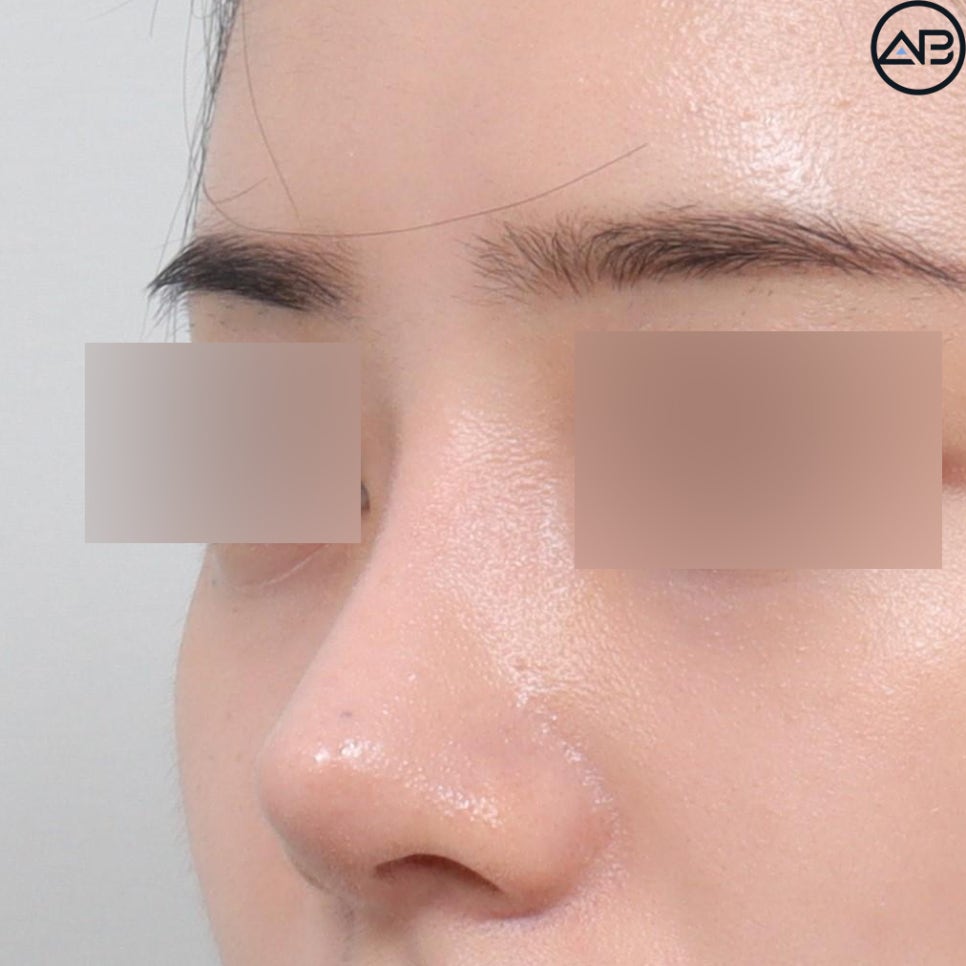 AB Plastic Surgery Refined Rhinoplasty - Revision Surgery Case Review image 3