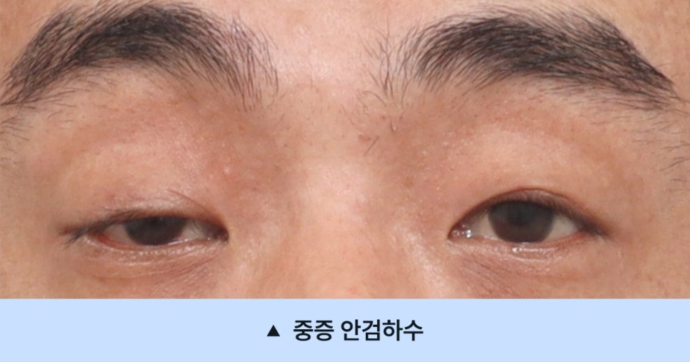 [눈매교정 하면 안되는 이유, 중증 안검하수의 진실] 관련 이미지 2
