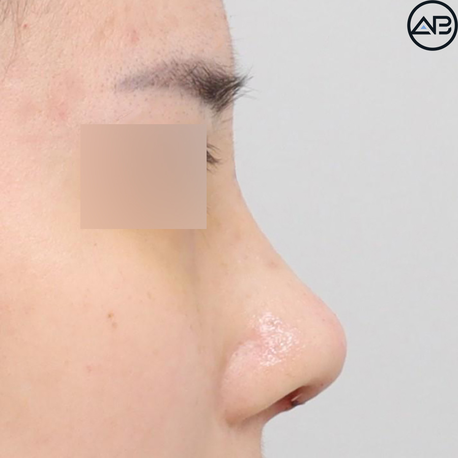 에이비성형외과 자려한코성형 케이스리뷰 관련 이미지 8