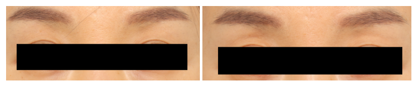 [Column] Can Sunken Eyelids Be Improved Too? image 4