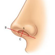 Q. 비순각성형이랑 비주성형이 정확히 뭔가요? 같은 말인걸까요? 관련 이미지 2