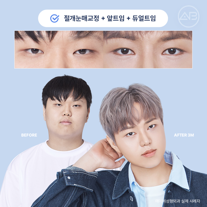 인상을 바꾸는 첫 시작, 에이비성형외과 남자눈성형 관련 이미지 23
