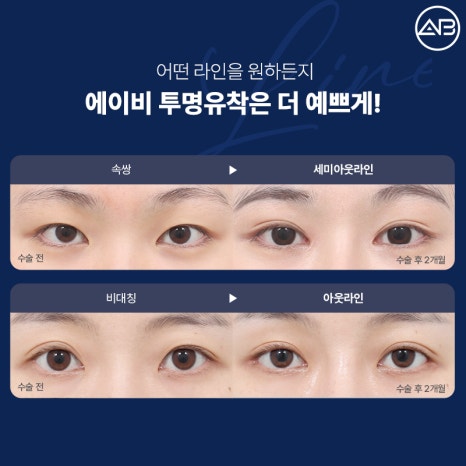 처음부터 예뻤던 것처럼, 에이비성형외과 자려한투명유착 관련 이미지 4