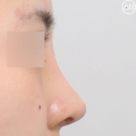 Case Review of Bulbous Nose Surgery That Transformed the Face into a Natural and Refined Look (feat. AB Plastic Surgery) image 6