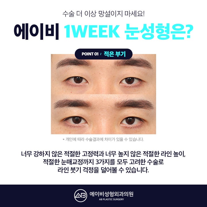남자눈성형후기 AB성형외과는 남달라 관련 이미지 1