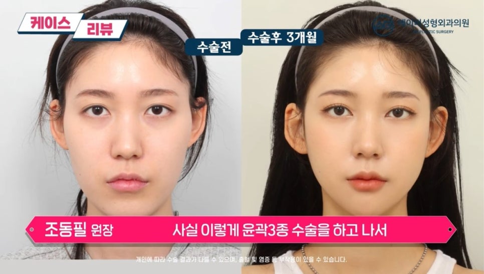 #에이비성형외과#에이비tv#케이스리뷰#안면윤곽성형 관련 이미지 8