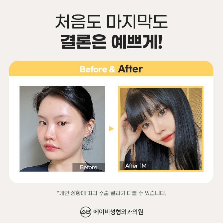 자가연골코성형 나라면 여기서 관련 이미지 5